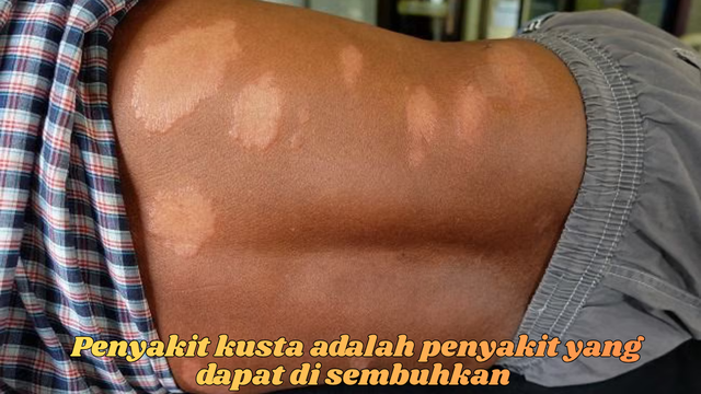 penyakit kusat